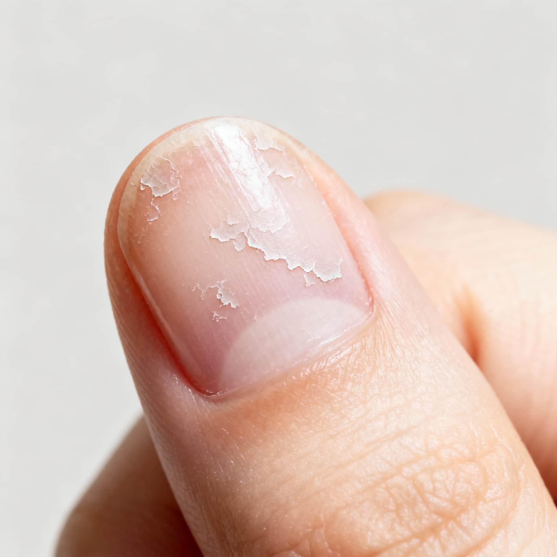 8 Top Solutions for Peeling Nails: Rescue Your Nail Health Today! 1 Close-up of peeling nail layers